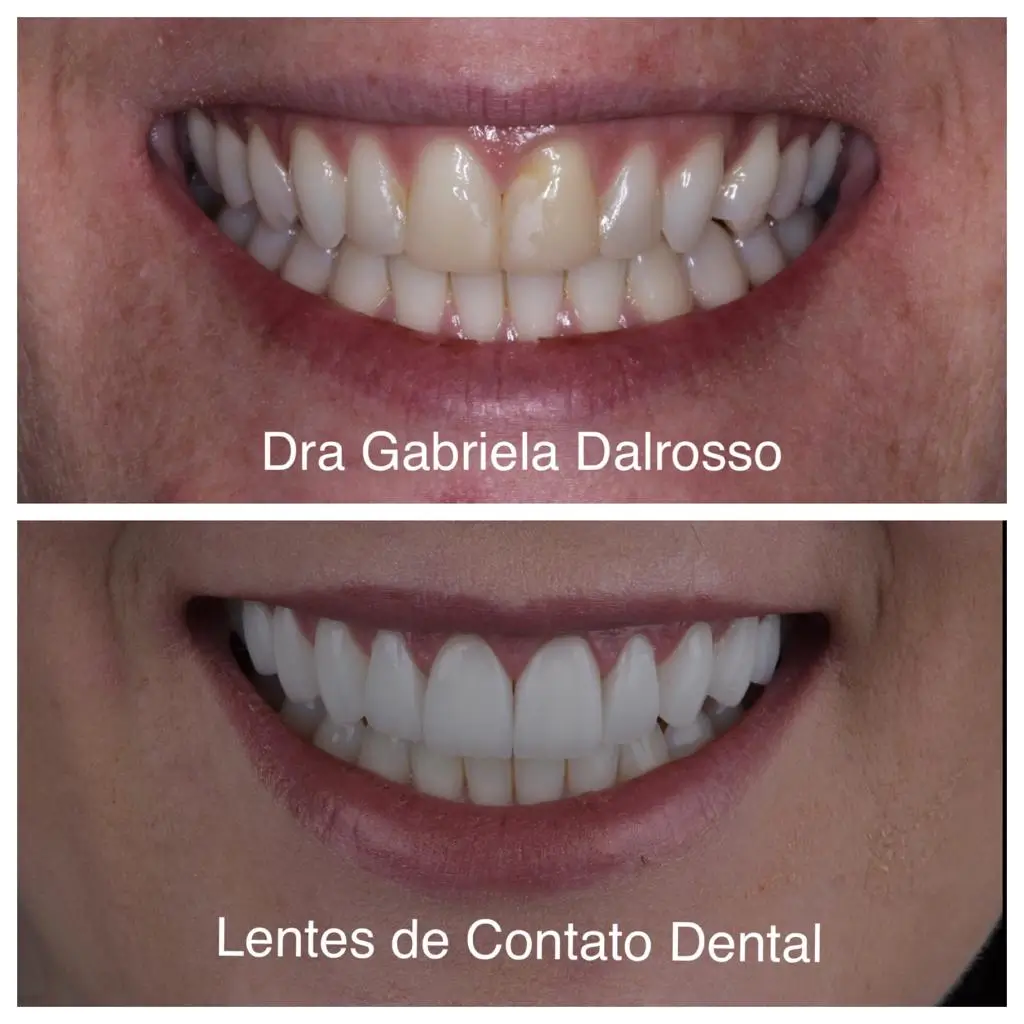 Lentes de Contato Dental